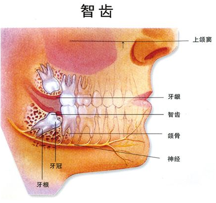 智齿发炎怎么办.png