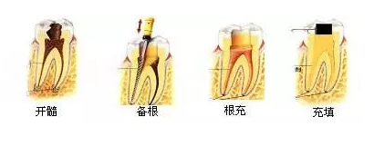不要再叫我"抽神经",请叫我"根管治疗"